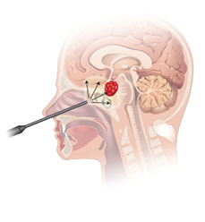 Endonasal Surgery